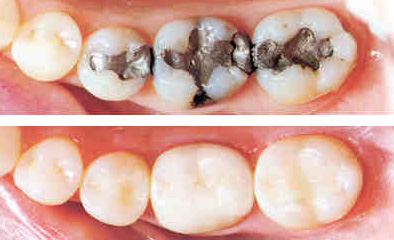 White versus silver amalgam dental filings